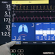 Una máquina de oxigenación por membrana extracorpórea (ECMO) conectada a un paciente con covid-19 en la unidad de cuidados intensivos del hospital al-Ahli en la ciudad cisjordana de Hebrón el 19 de marzo de 2021.